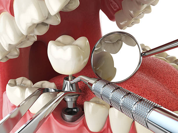 Emergency Dentist for Dental Implants